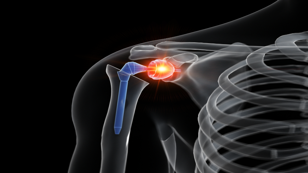 Reemplazo de hombro: Desde los defectos glenoideos, hasta los vástagos cortos
